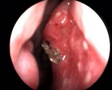 慢性鼻炎的發(fā)病原因?成都耳鼻喉醫(yī)院分析