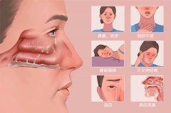 引起慢性鼻炎的原因有哪些?成都耳鼻喉醫(yī)院分析