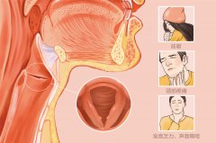 兒童聲帶小結危害大,不可不治!成都仁品耳鼻喉醫院解答