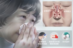 鼻甲肥大危害有什么?成都耳鼻喉醫院解答