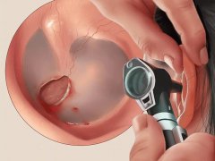 成都鼓膜穿孔都需要做哪些檢查?