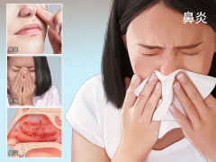 成都鼻炎會引起哪些癥狀?如何減少鼻炎發(fā)作?