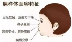 孩子腺樣體肥大有哪些征兆?成都耳鼻喉科醫生解答